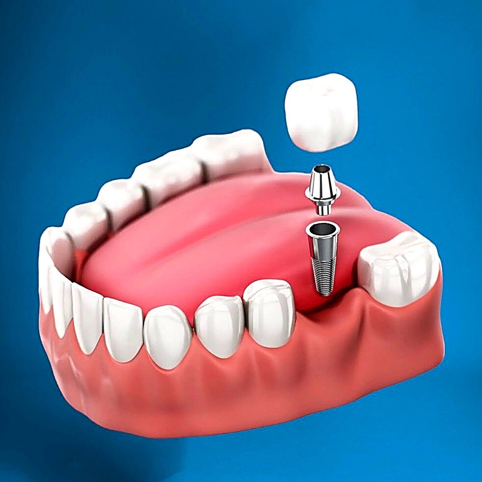 All-on-4 full-arch restoration result at Top Dental Care